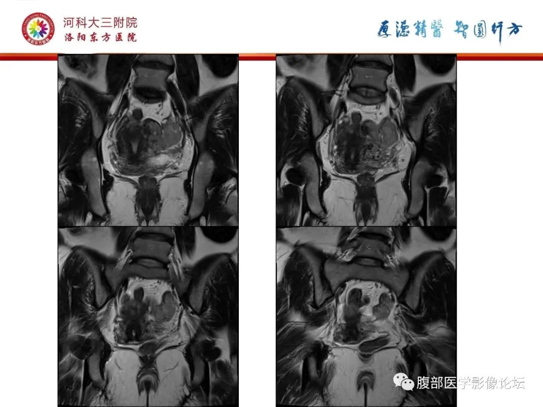 影像PPT - 【病例】静脉内平滑肌瘤病1例CT及MR影像-20
