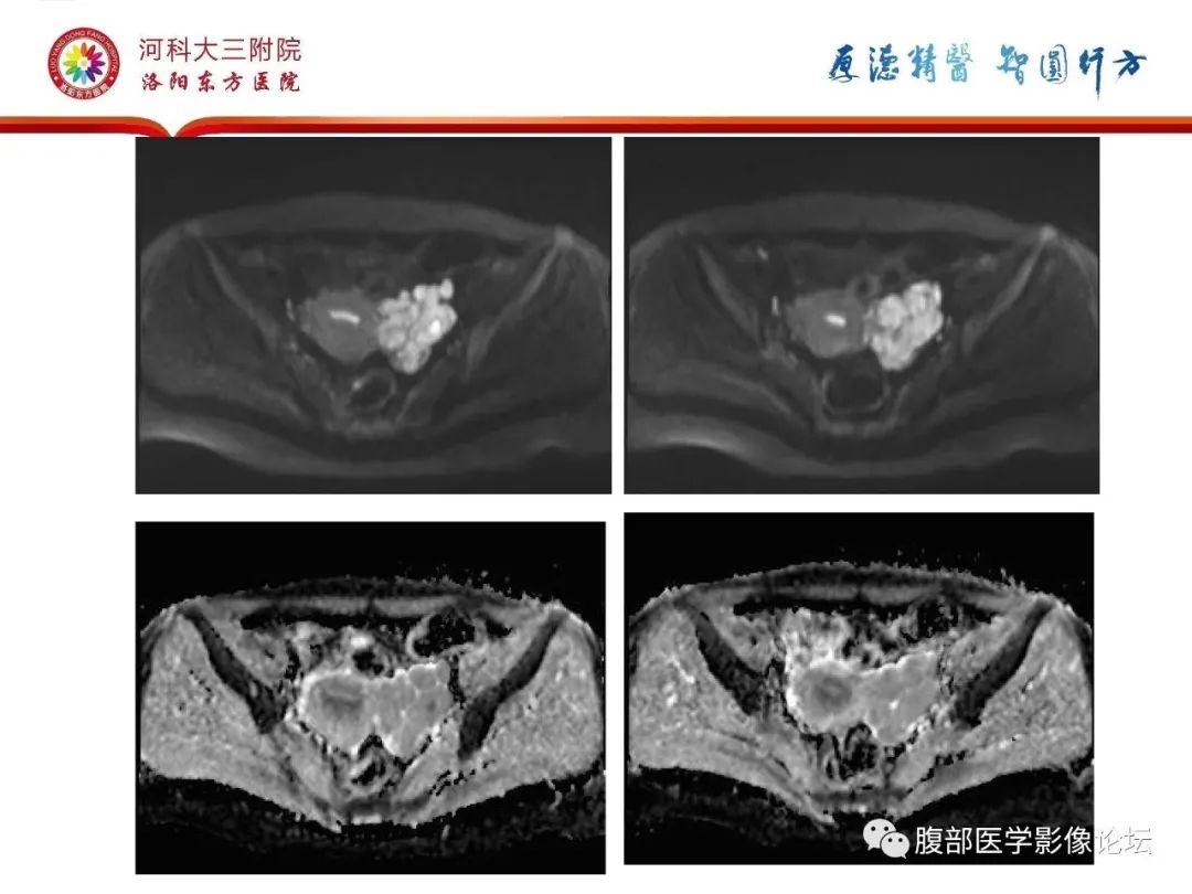 影像PPT - 【病例】静脉内平滑肌瘤病1例CT及MR影像-21