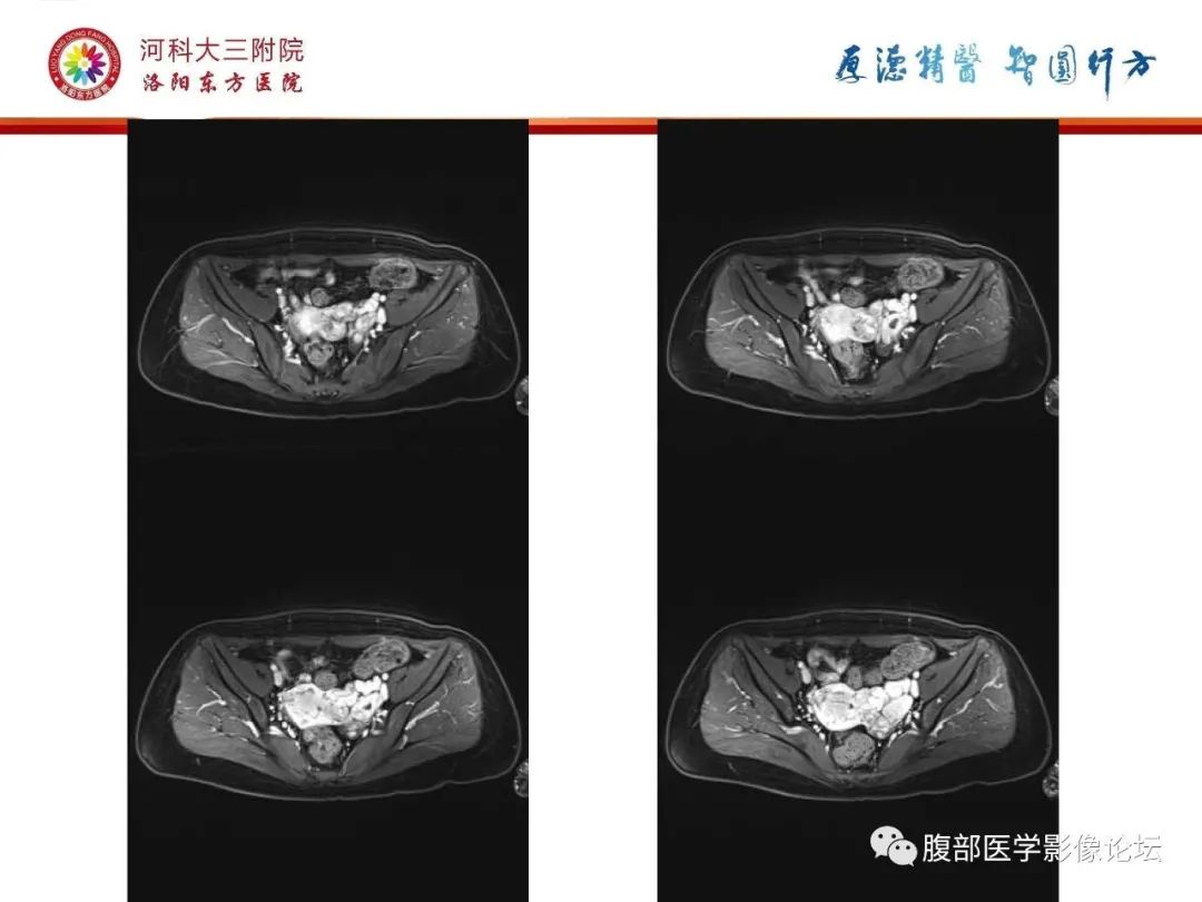 影像PPT - 【病例】静脉内平滑肌瘤病1例CT及MR影像-22