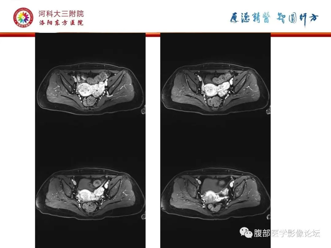 影像PPT - 【病例】静脉内平滑肌瘤病1例CT及MR影像-23
