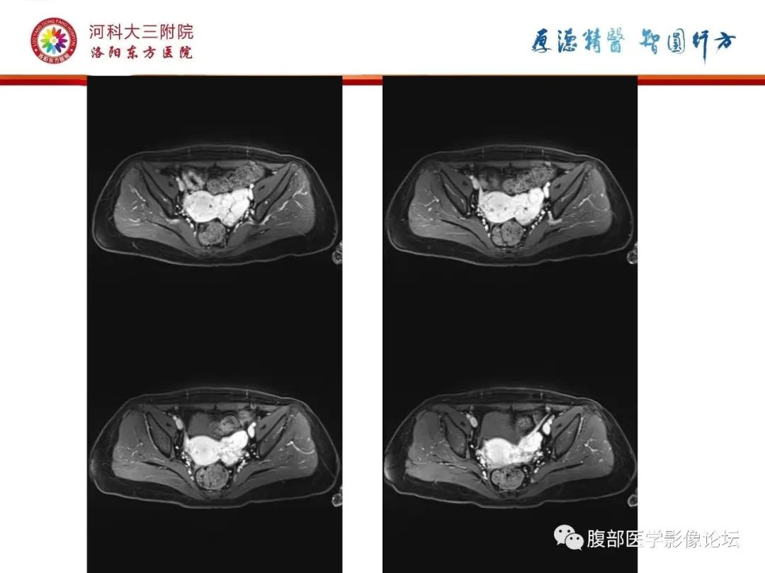 影像PPT - 【病例】静脉内平滑肌瘤病1例CT及MR影像-24