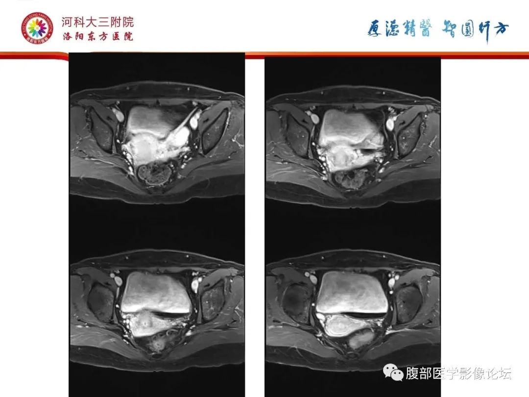 影像PPT - 【病例】静脉内平滑肌瘤病1例CT及MR影像-25