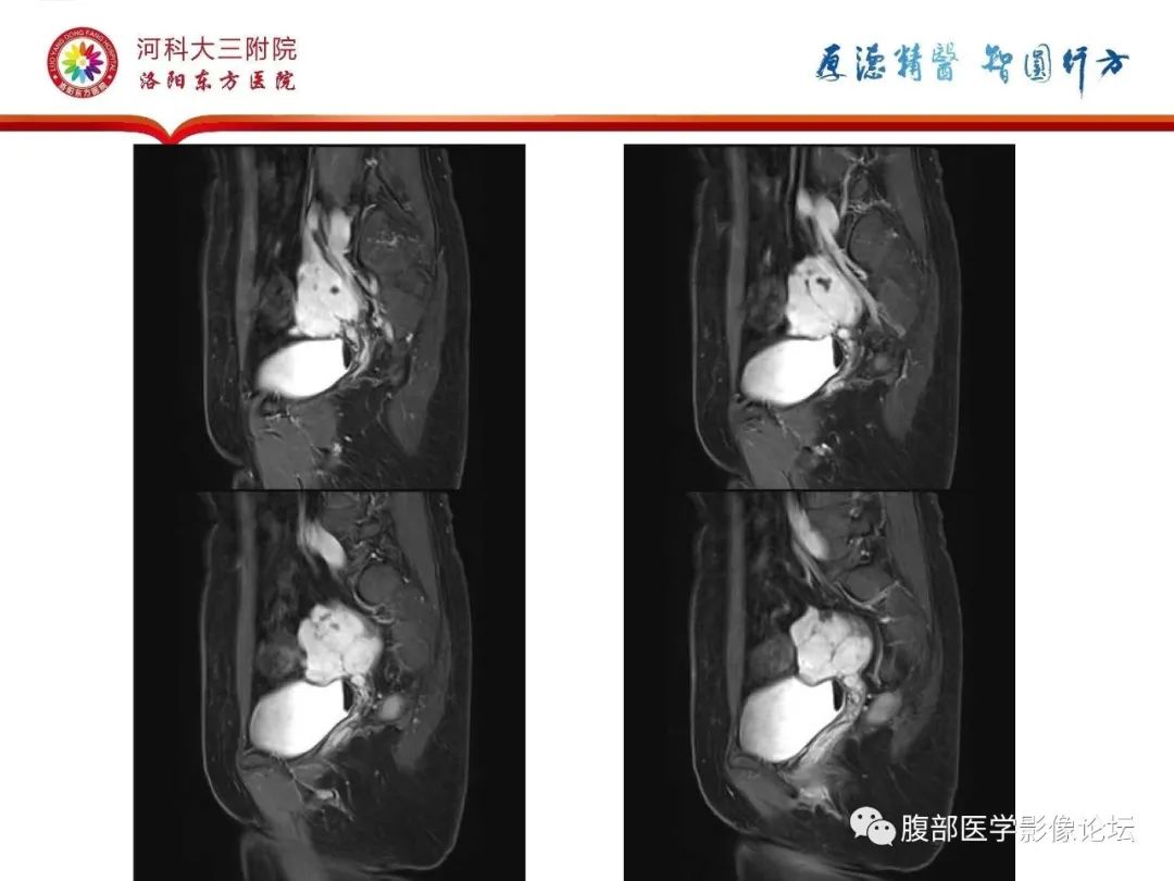 影像PPT - 【病例】静脉内平滑肌瘤病1例CT及MR影像-26