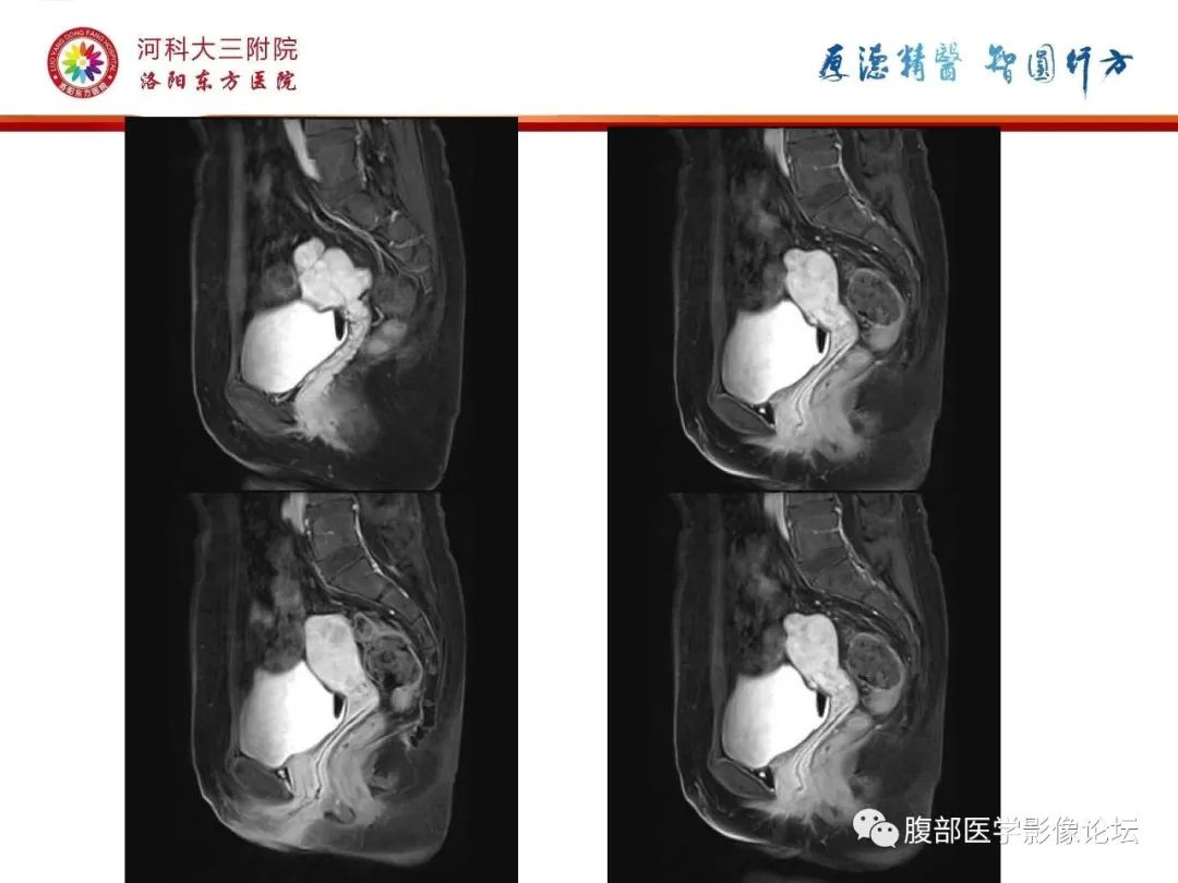 影像PPT - 【病例】静脉内平滑肌瘤病1例CT及MR影像-27