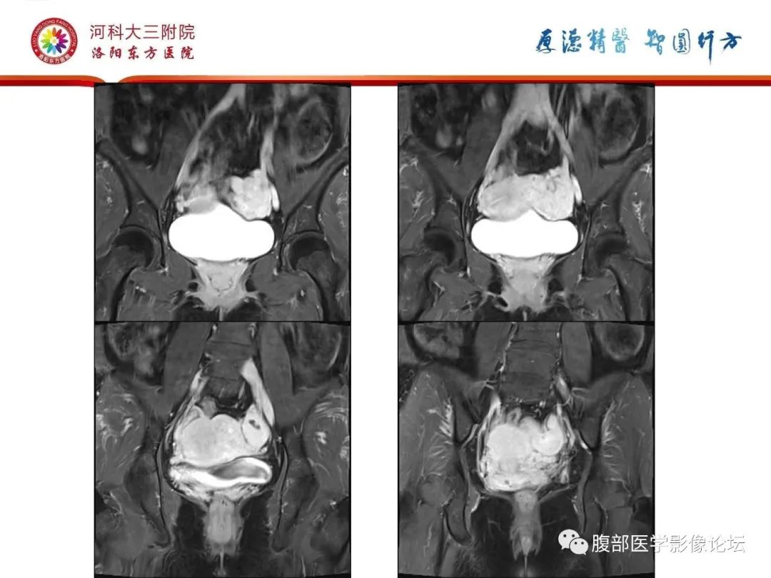 影像PPT - 【病例】静脉内平滑肌瘤病1例CT及MR影像-28