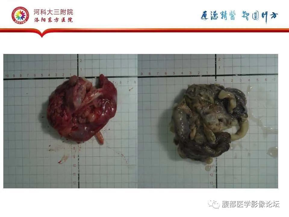 影像PPT - 【病例】静脉内平滑肌瘤病1例CT及MR影像-30