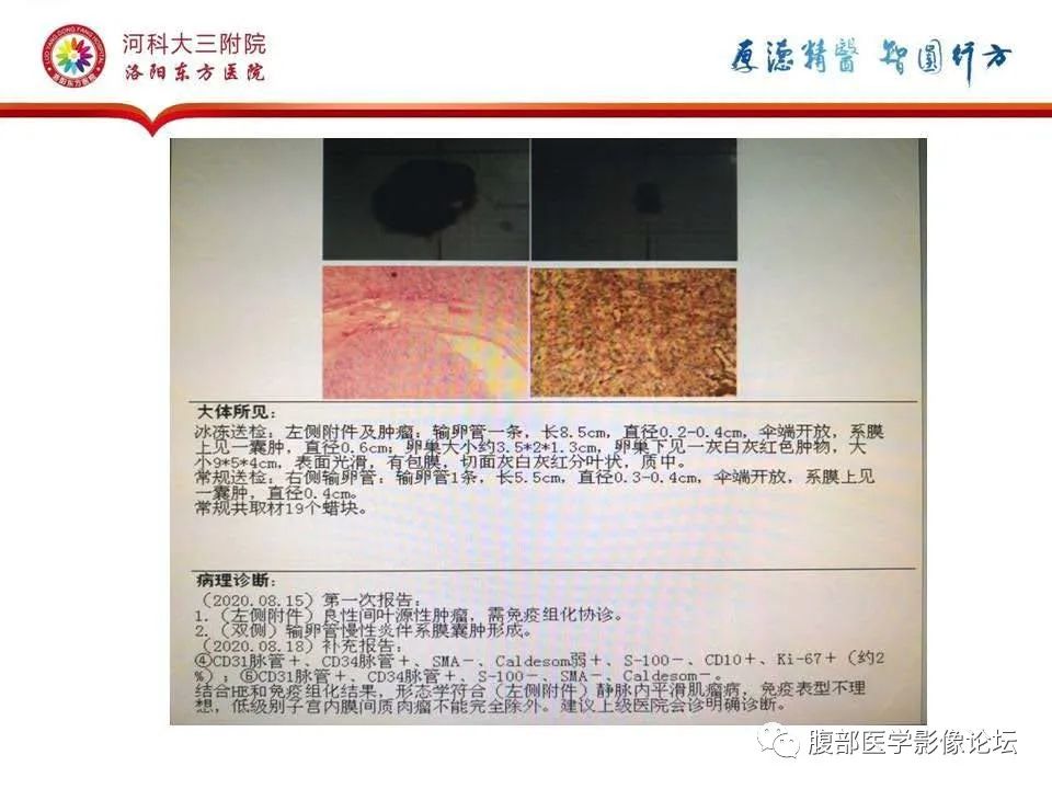 影像PPT - 【病例】静脉内平滑肌瘤病1例CT及MR影像-31