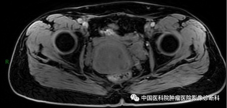 影像PPT - 【病例】子宫内膜间质肉瘤1例MR影像-3