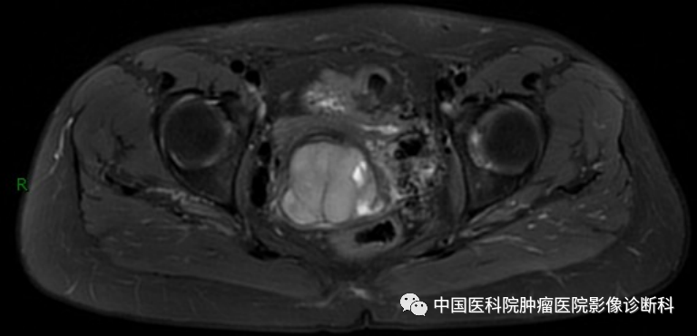 影像PPT - 【病例】子宫内膜间质肉瘤1例MR影像-6