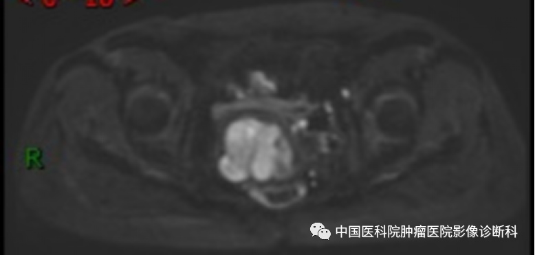 影像PPT - 【病例】子宫内膜间质肉瘤1例MR影像-7