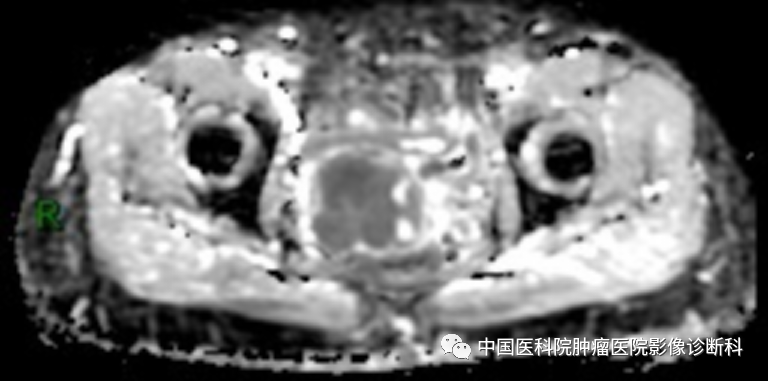 影像PPT - 【病例】子宫内膜间质肉瘤1例MR影像-8