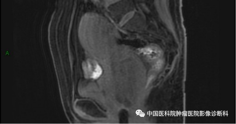 影像PPT - 【病例】子宫内膜间质肉瘤1例MR影像-9