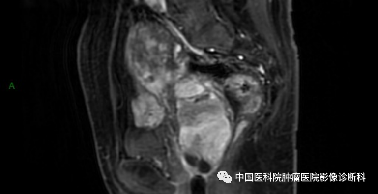 影像PPT - 【病例】子宫内膜间质肉瘤1例MR影像-10