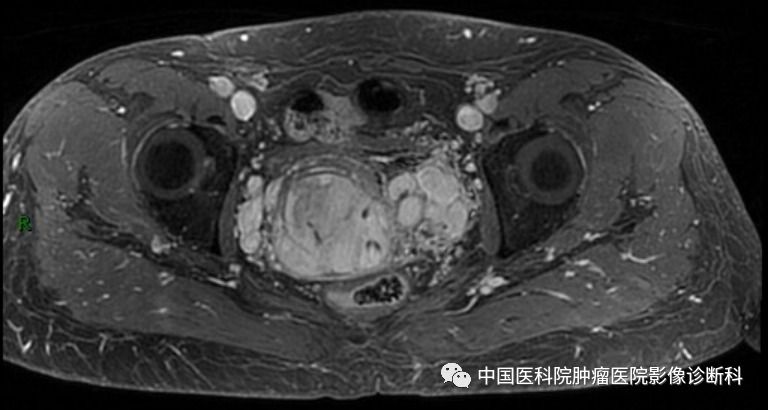 影像PPT - 【病例】子宫内膜间质肉瘤1例MR影像-11