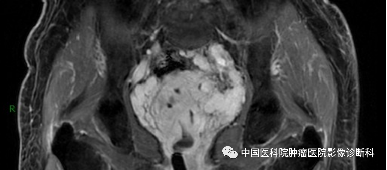 影像PPT - 【病例】子宫内膜间质肉瘤1例MR影像-12