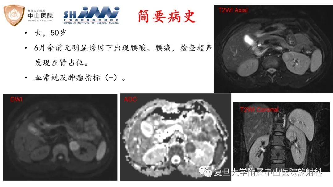 影像PPT - 【病例】后肾腺瘤1例MR影像诊断与鉴别-2