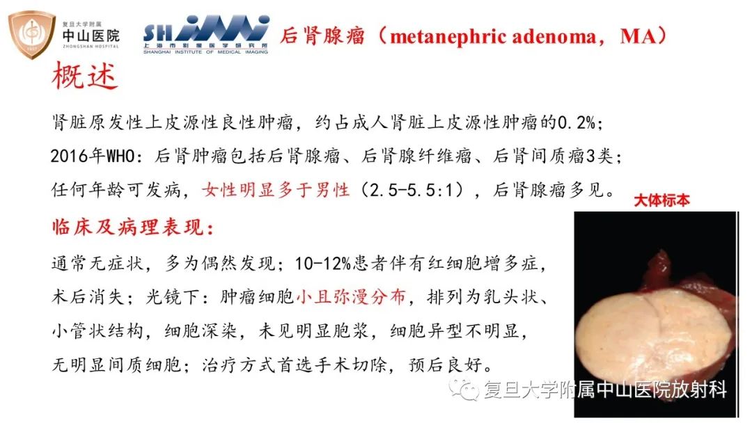 影像PPT - 【病例】后肾腺瘤1例MR影像诊断与鉴别-6