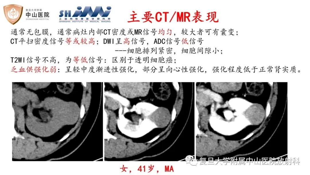 影像PPT - 【病例】后肾腺瘤1例MR影像诊断与鉴别-7