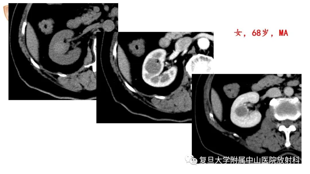 影像PPT - 【病例】后肾腺瘤1例MR影像诊断与鉴别-8