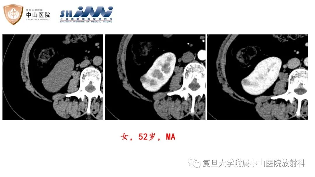 影像PPT - 【病例】后肾腺瘤1例MR影像诊断与鉴别-10