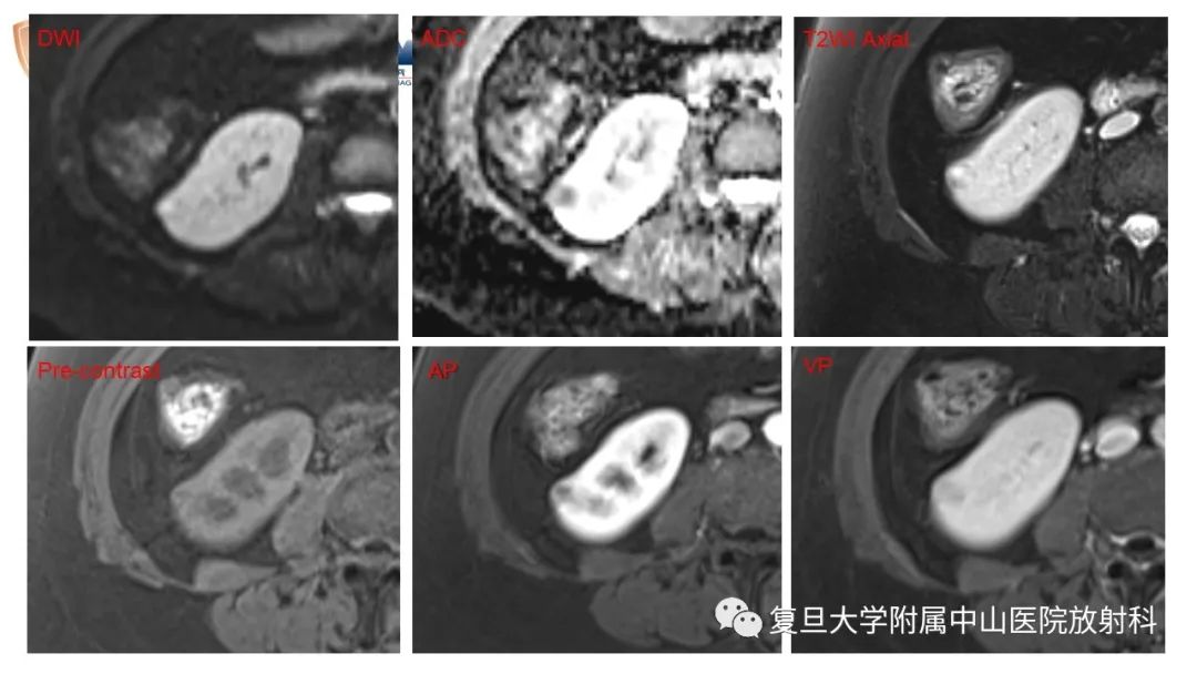 影像PPT - 【病例】后肾腺瘤1例MR影像诊断与鉴别-11