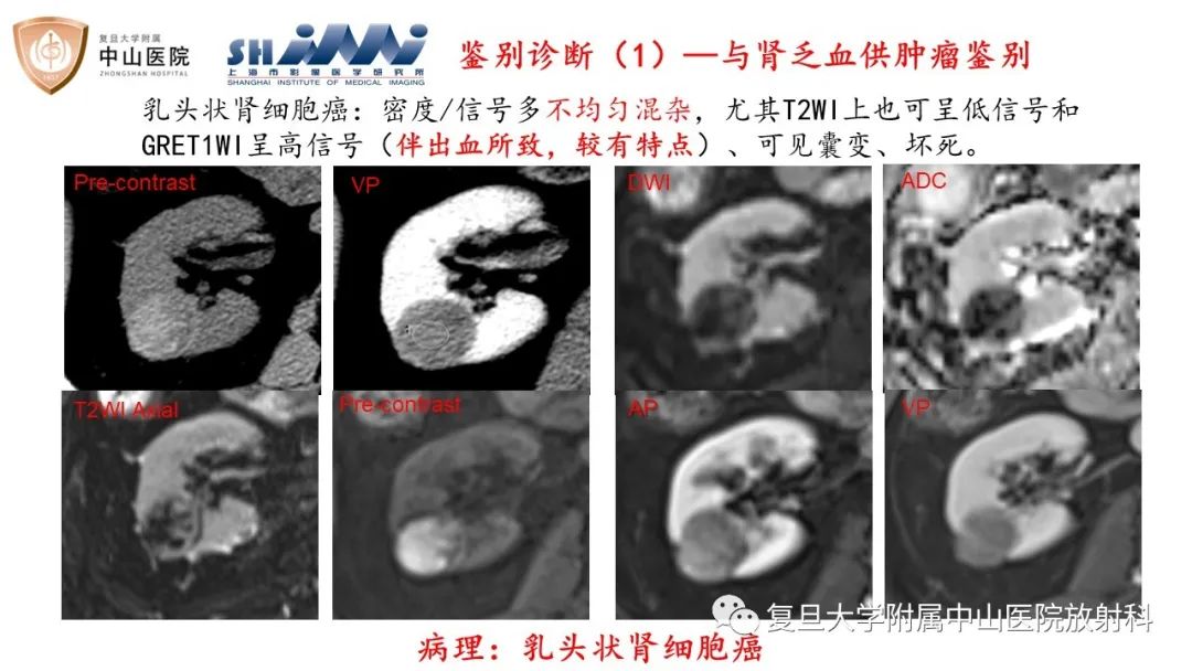 影像PPT - 【病例】后肾腺瘤1例MR影像诊断与鉴别-12