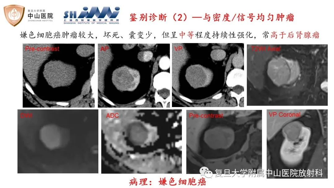 影像PPT - 【病例】后肾腺瘤1例MR影像诊断与鉴别-13