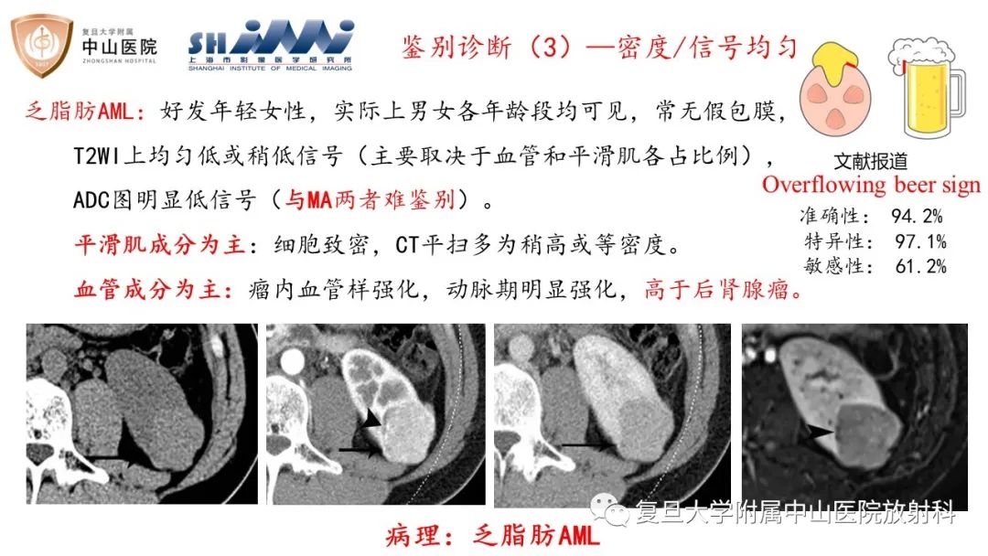 影像PPT - 【病例】后肾腺瘤1例MR影像诊断与鉴别-14
