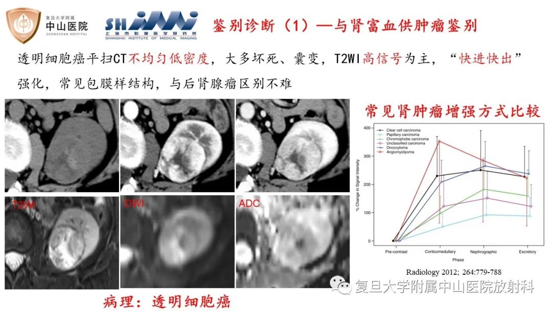 影像PPT - 【病例】后肾腺瘤1例MR影像诊断与鉴别-16