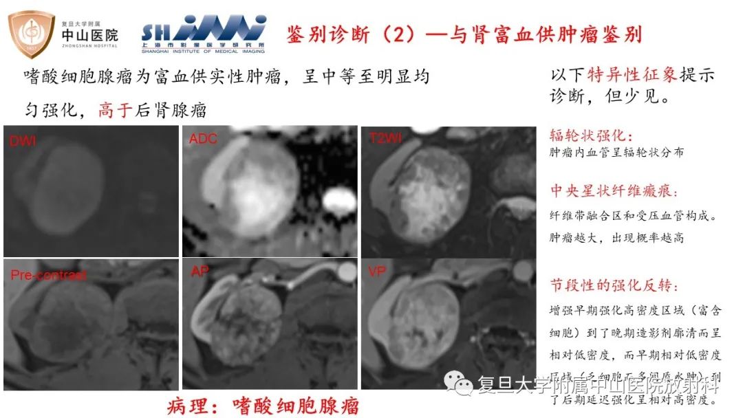 影像PPT - 【病例】后肾腺瘤1例MR影像诊断与鉴别-17