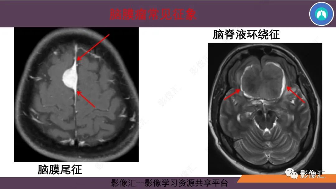影像PPT - 【PPT】脑膜瘤15种亚型影像诊断-5