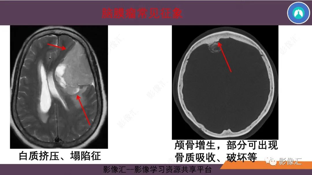 影像PPT - 【PPT】脑膜瘤15种亚型影像诊断-6