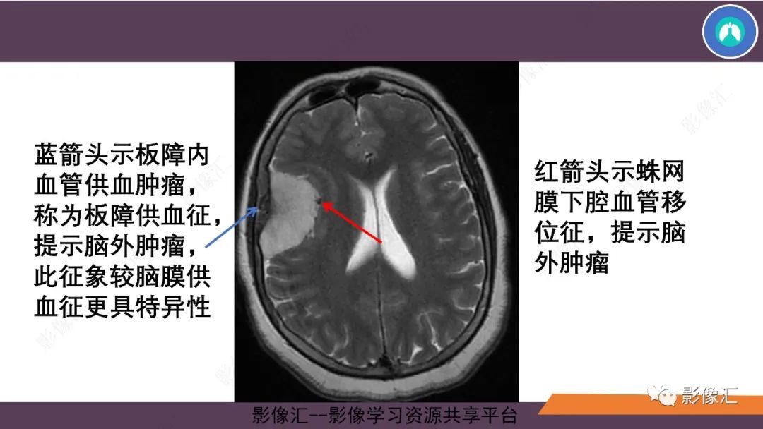 影像PPT - 【PPT】脑膜瘤15种亚型影像诊断-8