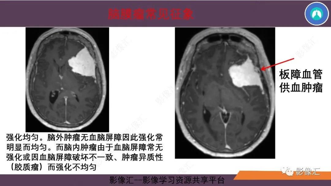 影像PPT - 【PPT】脑膜瘤15种亚型影像诊断-9