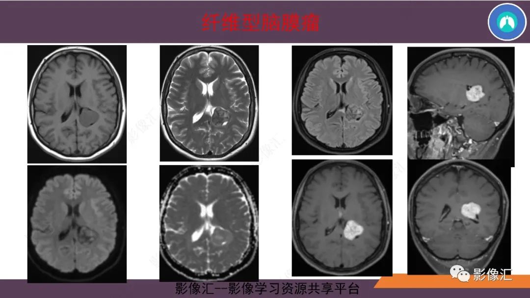 影像PPT - 【PPT】脑膜瘤15种亚型影像诊断-13