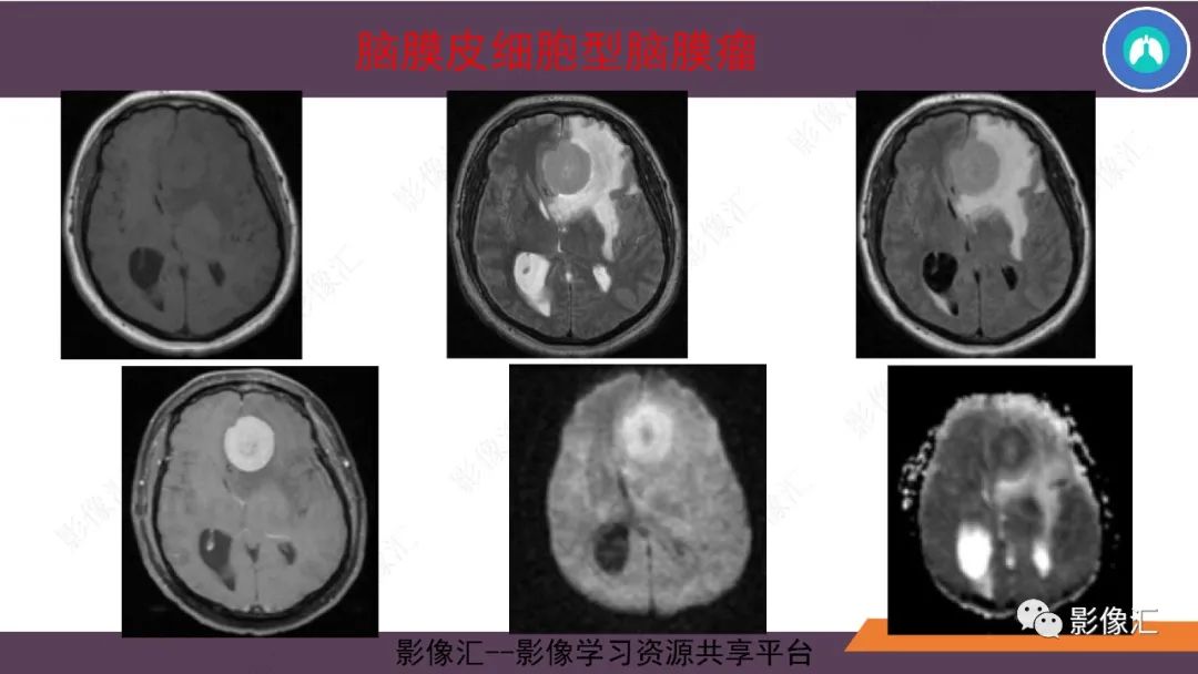 影像PPT - 【PPT】脑膜瘤15种亚型影像诊断-11
