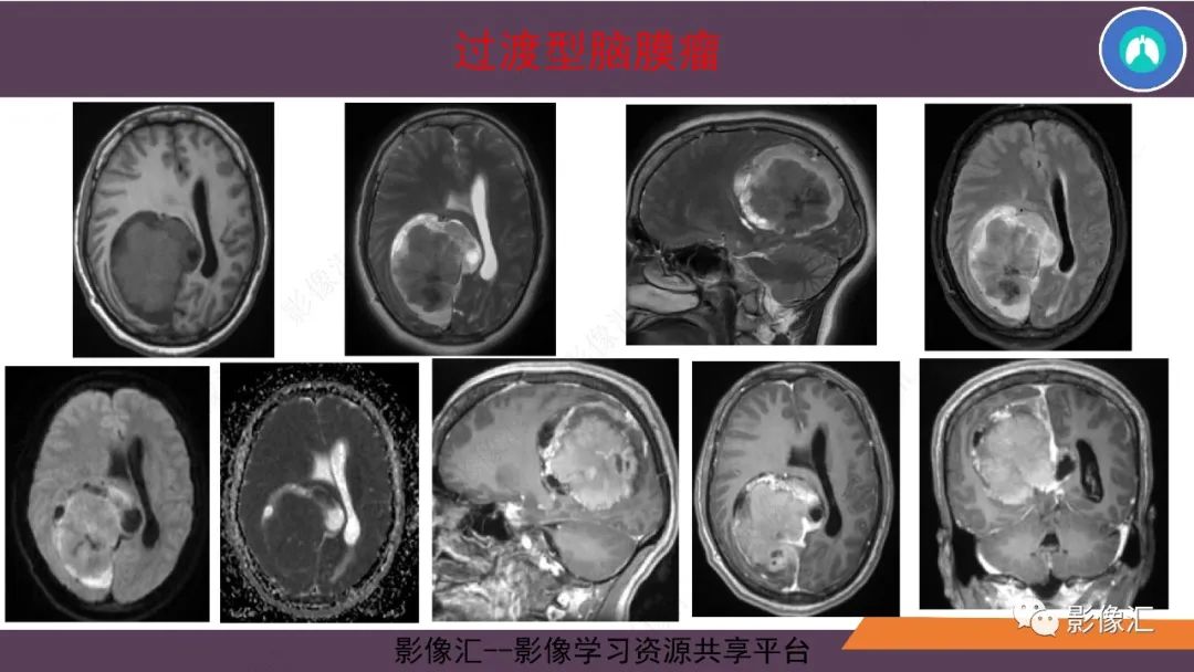 影像PPT - 【PPT】脑膜瘤15种亚型影像诊断-15