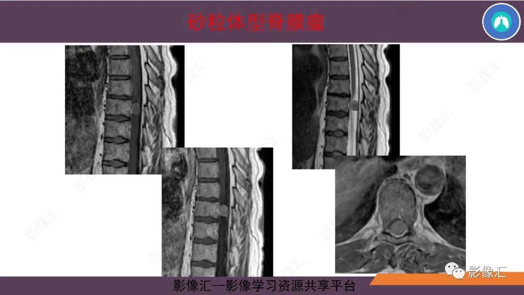 影像PPT - 【PPT】脑膜瘤15种亚型影像诊断-18