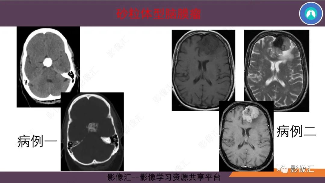 影像PPT - 【PPT】脑膜瘤15种亚型影像诊断-17