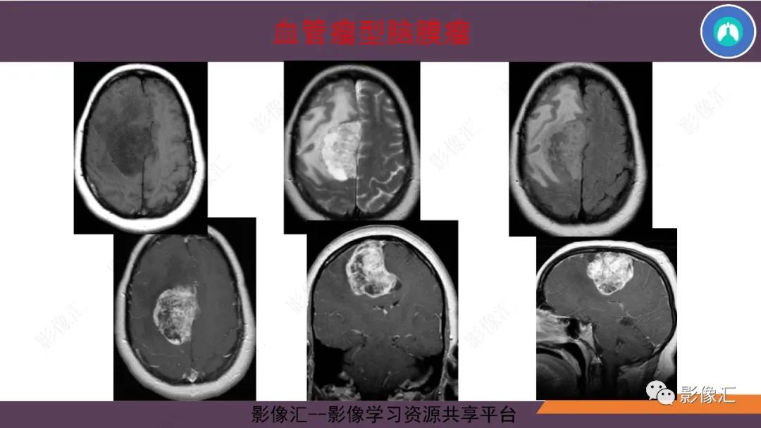 影像PPT - 【PPT】脑膜瘤15种亚型影像诊断-20