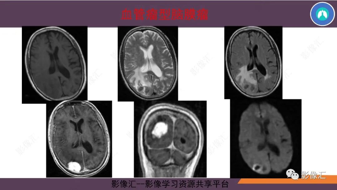 影像PPT - 【PPT】脑膜瘤15种亚型影像诊断-21
