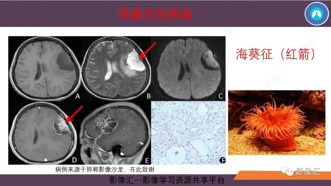 影像PPT - 【PPT】脑膜瘤15种亚型影像诊断-23