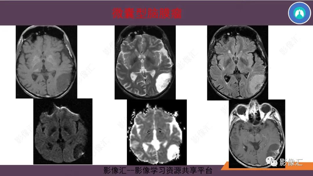 影像PPT - 【PPT】脑膜瘤15种亚型影像诊断-24