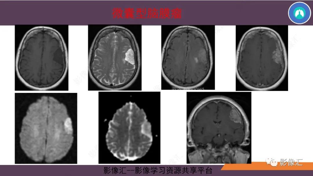 影像PPT - 【PPT】脑膜瘤15种亚型影像诊断-25