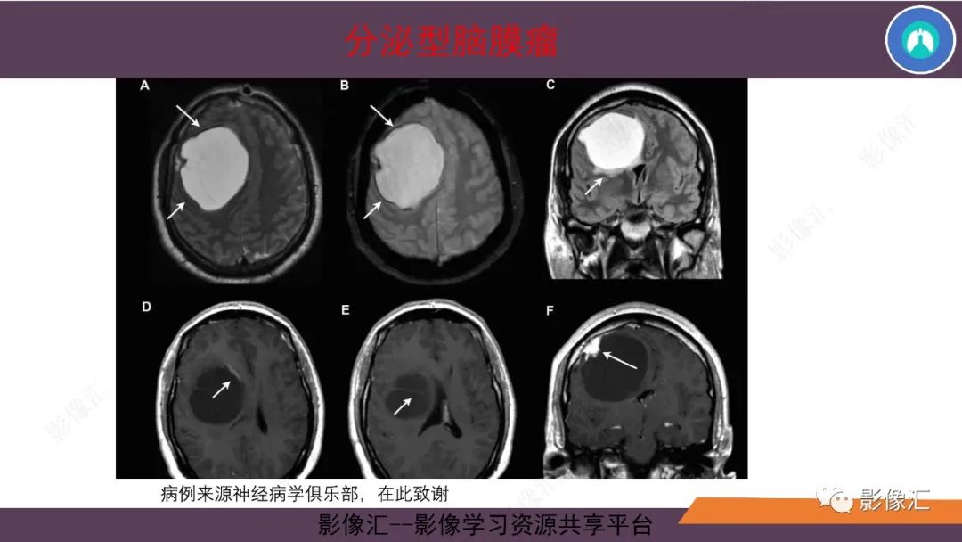 影像PPT - 【PPT】脑膜瘤15种亚型影像诊断-27
