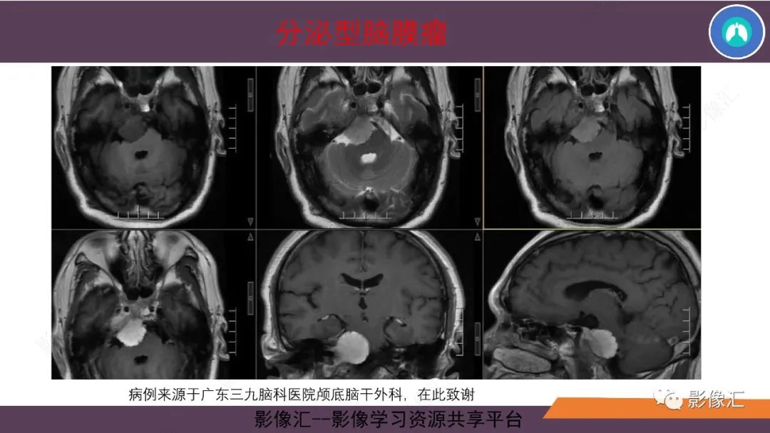 影像PPT - 【PPT】脑膜瘤15种亚型影像诊断-28