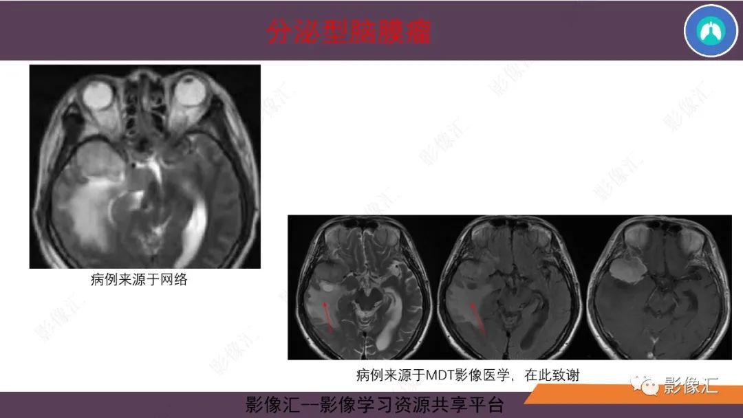 影像PPT - 【PPT】脑膜瘤15种亚型影像诊断-29