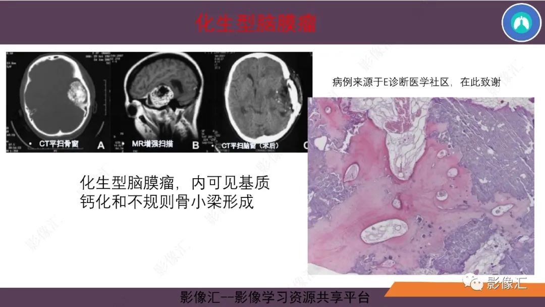 影像PPT - 【PPT】脑膜瘤15种亚型影像诊断-31