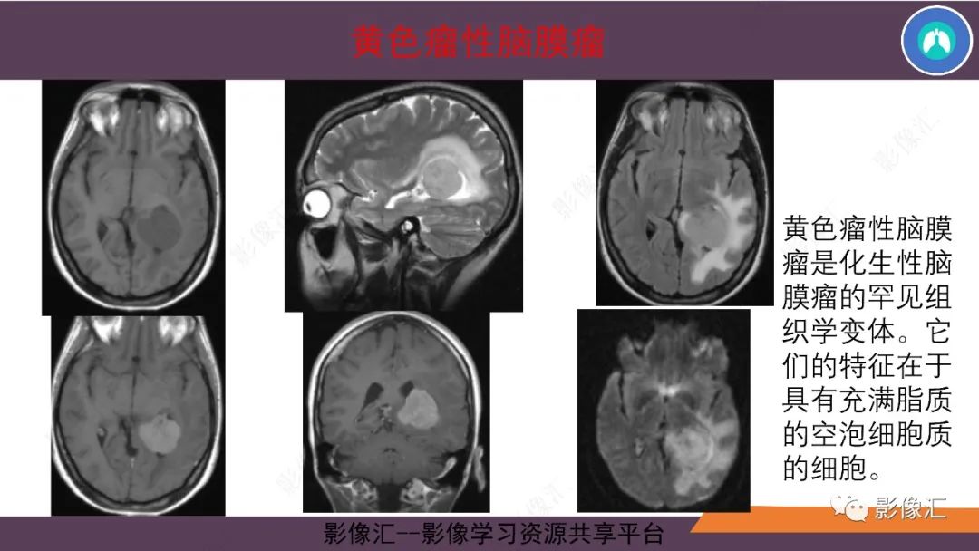 影像PPT - 【PPT】脑膜瘤15种亚型影像诊断-32