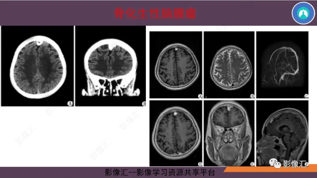 影像PPT - 【PPT】脑膜瘤15种亚型影像诊断-33